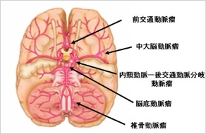 脳血管