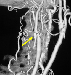 術前頚動脈狭窄所見