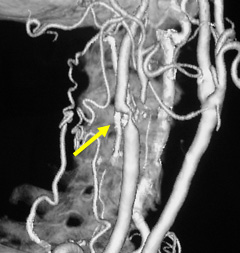 術前頚動脈狭窄所見