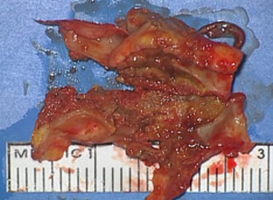 剥離摘出したプラーク